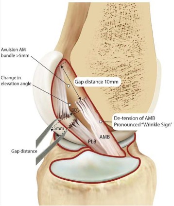 The Evolution of ACL Management – Singapore Physio